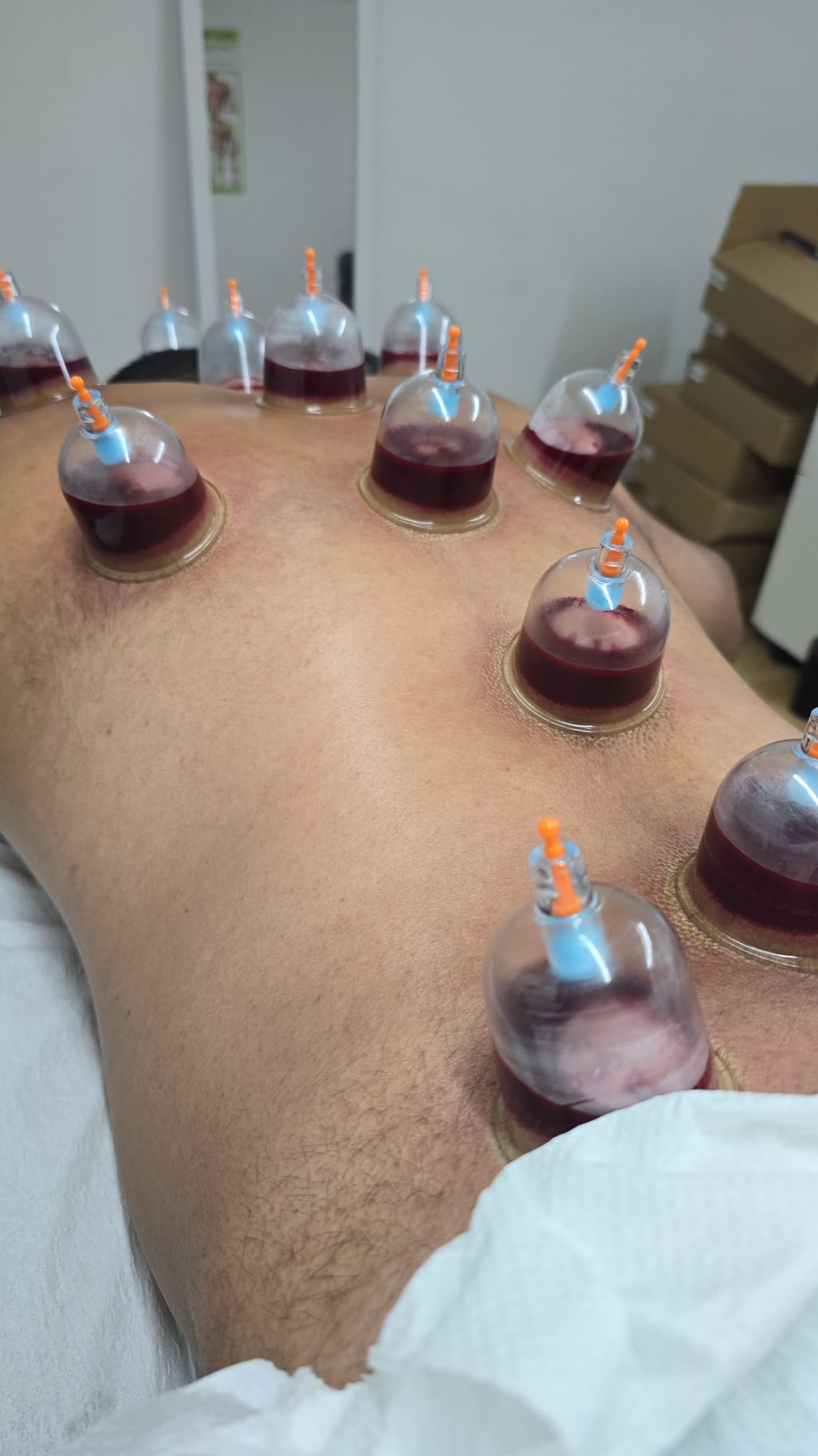Wet cupping treatment on back