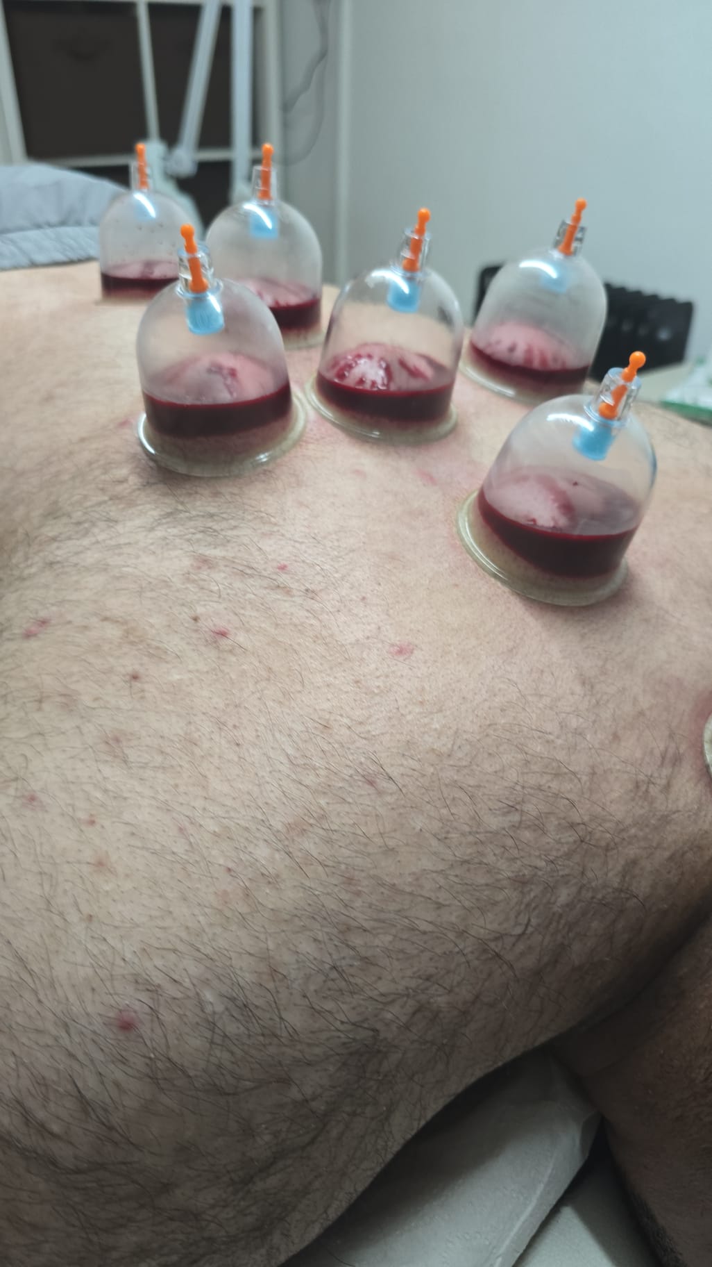 Hijama cups on upper back