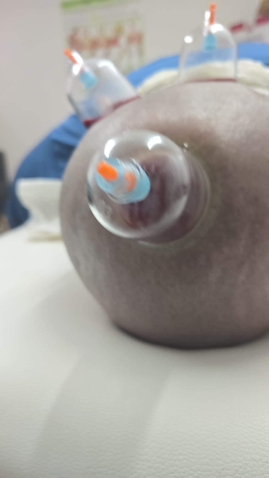 Close-up of cupping on scalp