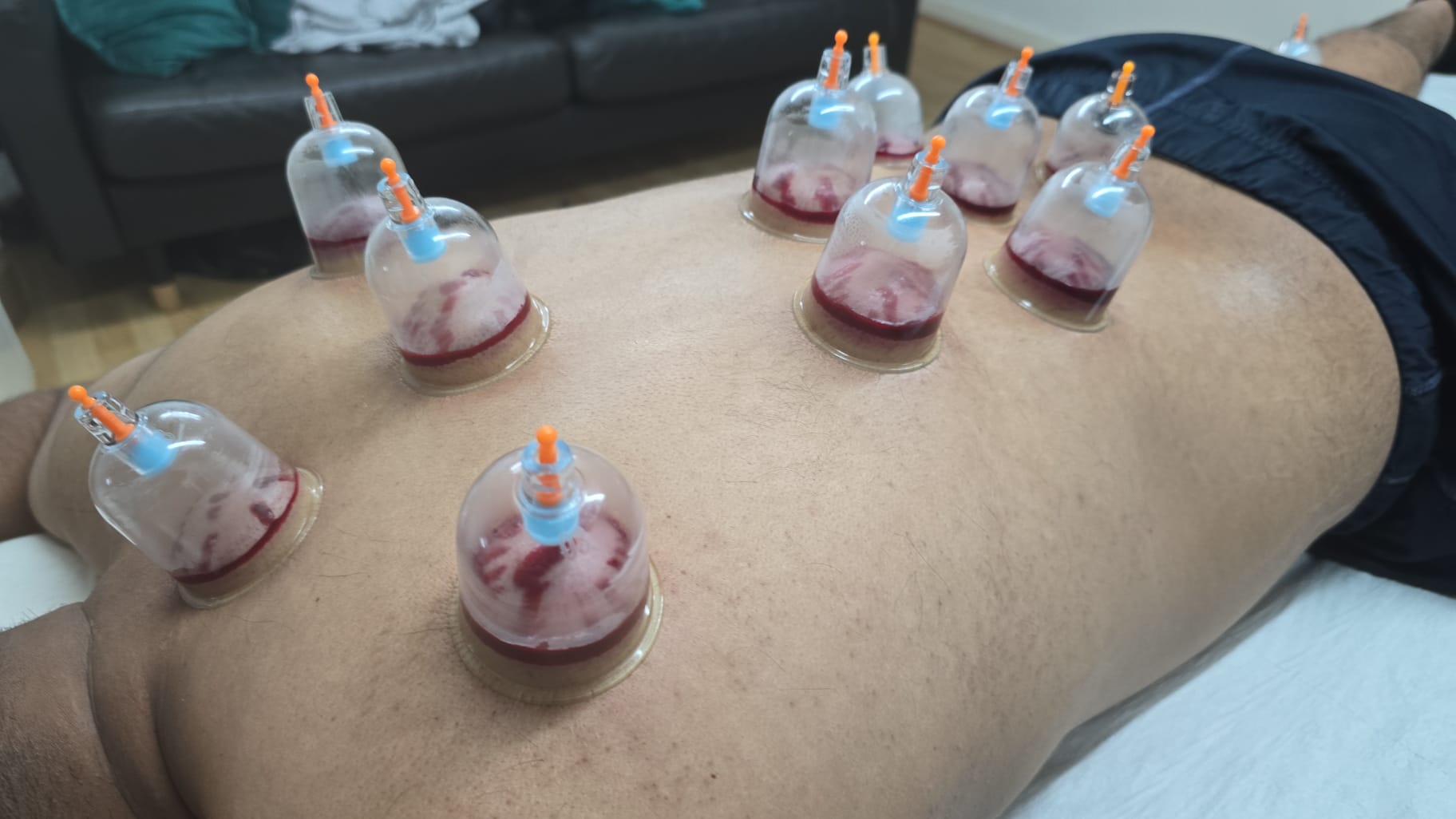 Wet cupping results