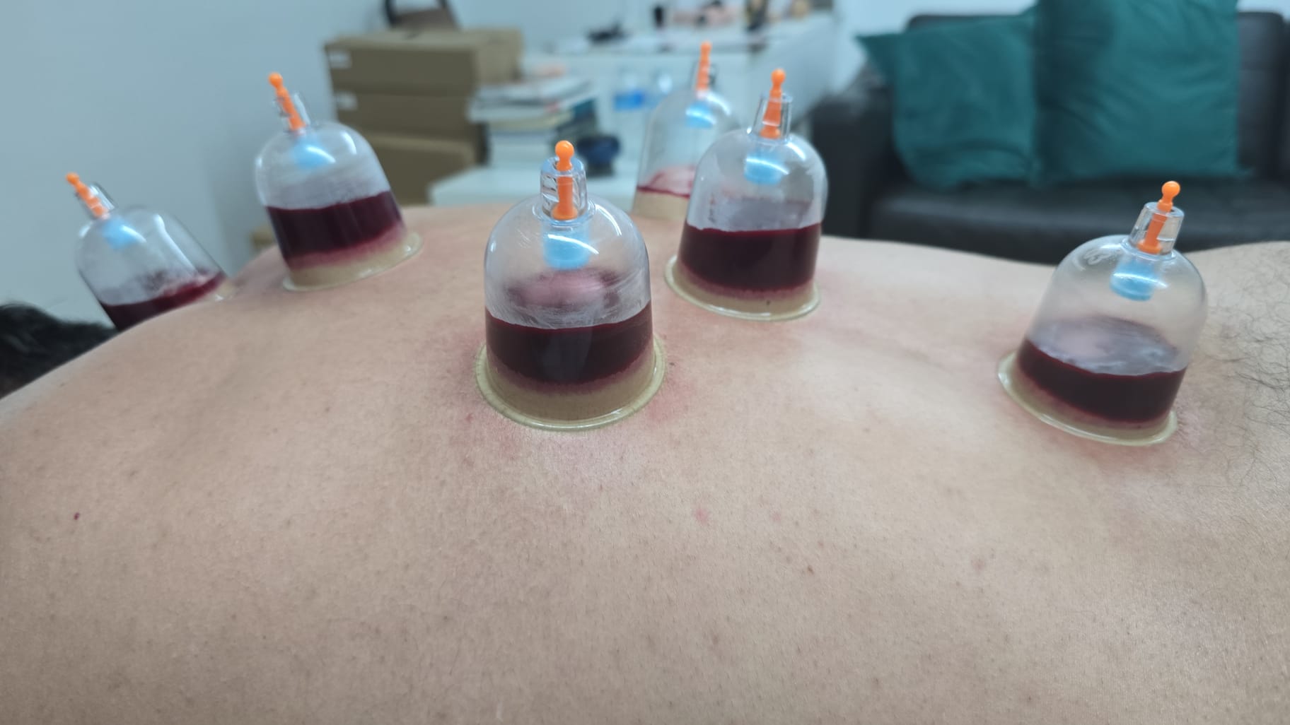 Wet cupping session