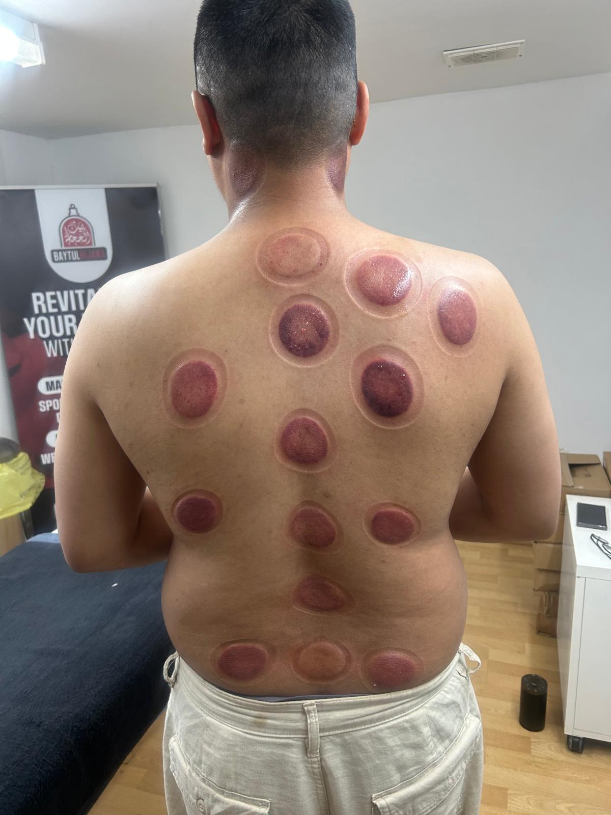 Client after Hijama session