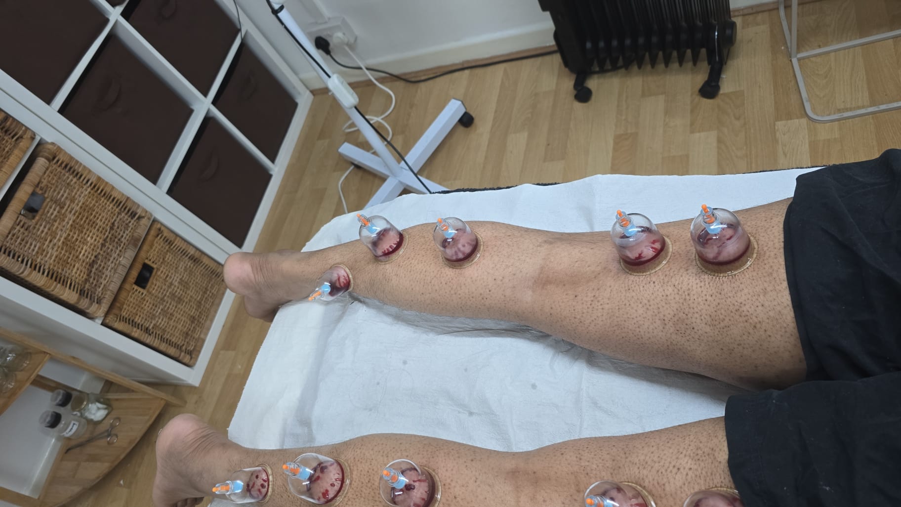 Cupping therapy on legs