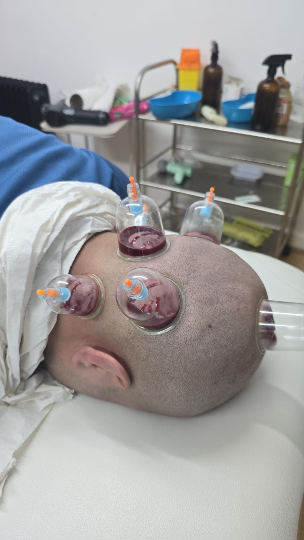 Head and neck cupping treatment
